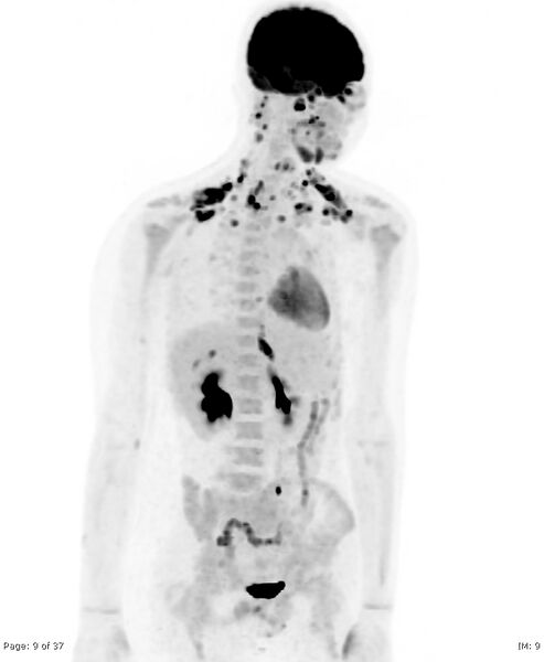 File:Brown fat uptake (FDG PET-CT) (Radiopaedia 77392-89513 MIP 8).jpg