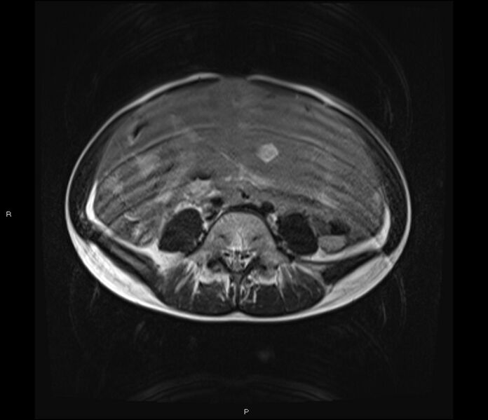 File:Burkitt lymphoma (bowel) (Radiopaedia 68839-78557 Axial T2 41).jpg