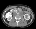 Burned-out testicular choriocarcinoma (Radiopaedia 32822-34040 B 10).PNG