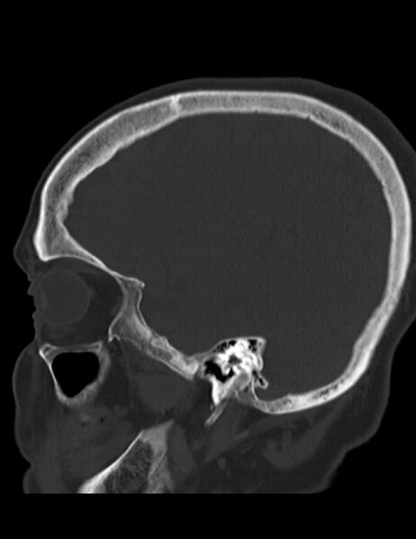 File:Burnt-out meningioma (Radiopaedia 51557-57337 Sagittal bone window 33).jpg