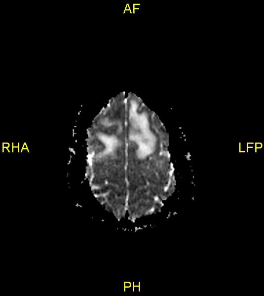File:Butterfly glioma (Radiopaedia 76707-88526 Axial ADC 25).jpg