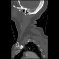 C1 anterior arch (plough) fracture - type 1 (Radiopaedia 76181-87720 Sagittal bone window 16).jpg