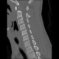 C5 facet fracture (Radiopaedia 58374-65499 Sagittal bone window 40).jpg