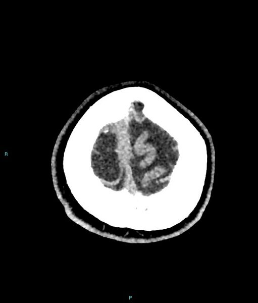 File:Calcified cerebral emboli from left ventricular thrombus (Radiopaedia 84420-99758 Axial non-contrast 9).jpg