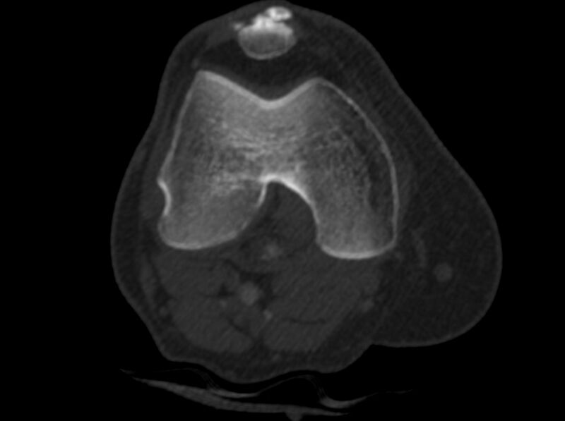 File:Calcified hematoma - popliteal fossa (Radiopaedia 63938-72763 C 3).jpg