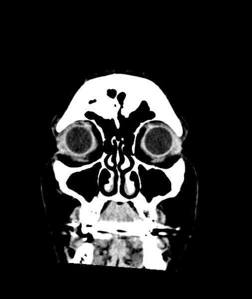 File:Calcified meningioma (Radiopaedia 74361-85243 Coronal non-contrast 1).jpg