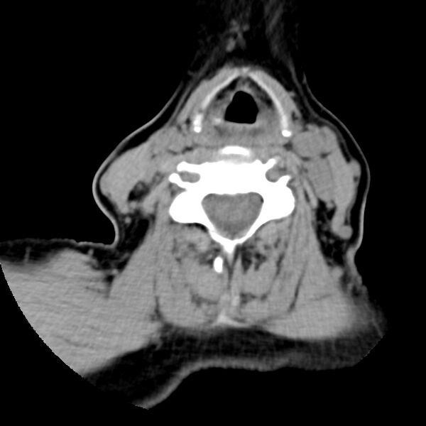 File:Calcified meningioma - cervical canal (Radiopaedia 70136-80171 B 21).jpg
