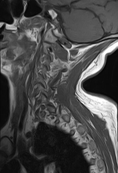 File:Calcified meningioma - cervical canal (Radiopaedia 70136-82468 Sagittal T1 3).jpg