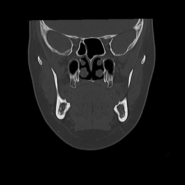File:Canal up mastoidectomy (Radiopaedia 78108-90638 Coronal bone window 15).jpg