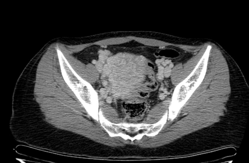 Cannonball metastases - uterine choriocarcinoma (Radiopaedia 70137-80174 A 18).jpg