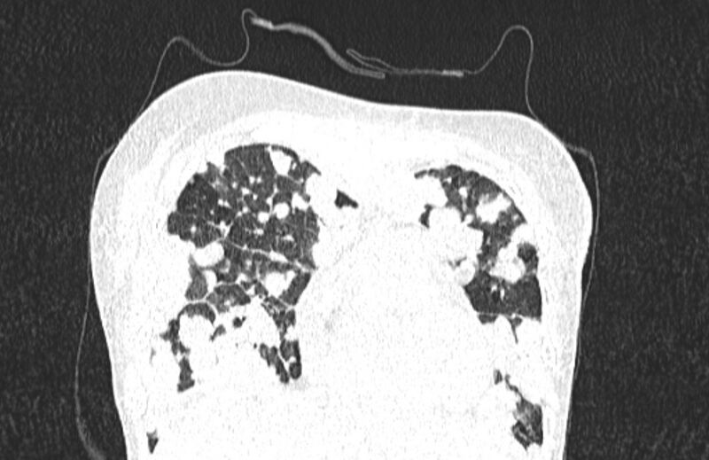 File:Cannonball metastases from breast cancer (Radiopaedia 91024-108569 Coronal lung window 31).jpg