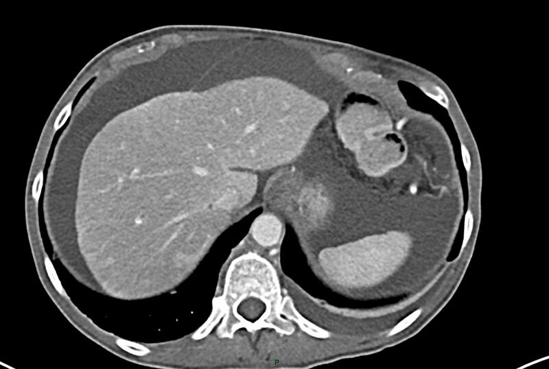 File:Carcinoid mesenteric tumor complicated by chylous ascites (Radiopaedia 76312-87953 A 10).jpg