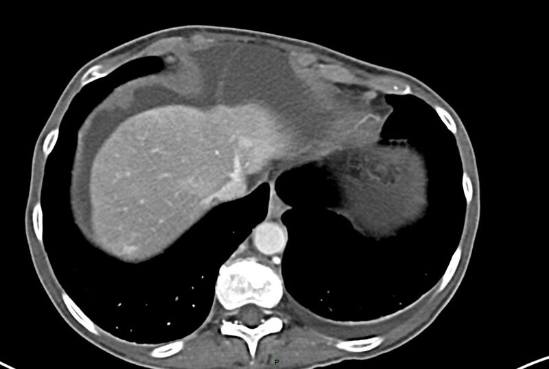 File:Carcinoid mesenteric tumor complicated by chylous ascites (Radiopaedia 76312-87953 A 6).jpg