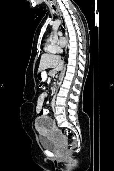 File:Carcinoma of uterine cervix (Radiopaedia 85861-101700 D 42).jpg