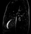 Cardiac hemangioma (Radiopaedia 16971-64065 Multiplanar 1).JPG