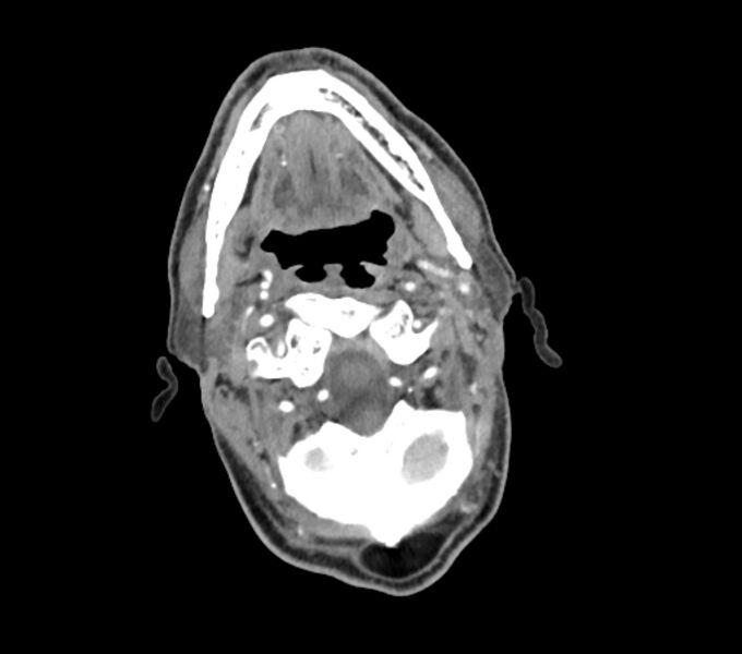 File:Carotid artery pseudoaneurysm (Radiopaedia 84030-99259 C 25).jpg