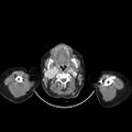 Carotid body tumor (Radiopaedia 21021-20948 A 15).jpg