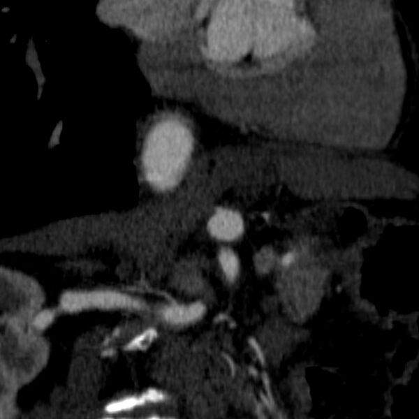 File:Celiac artery aneurysm (Radiopaedia 21574-21525 B 9).JPEG