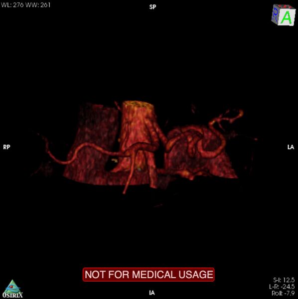 File:Celiac trunk variant anatomy - gastrohepatic trunk and splenic artery (Radiopaedia 38815-40995 B 3).jpg