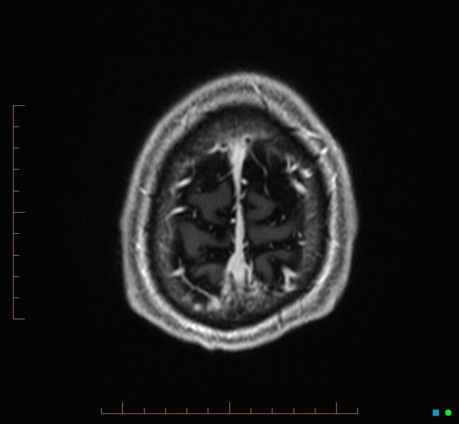 File:Cerebellar gangliocytoma (Radiopaedia 65377-74422 Axial T1 C+ 134).jpg