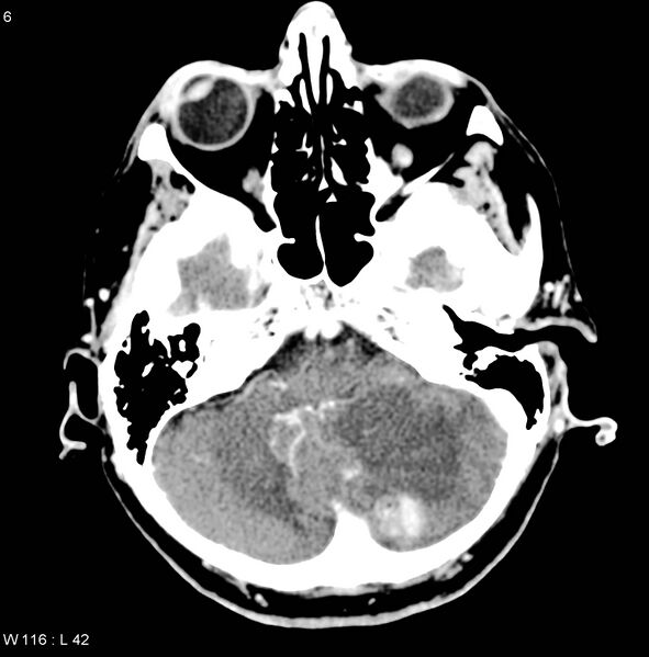 File:Cerebellar metastasis (Radiopaedia 5323).jpg