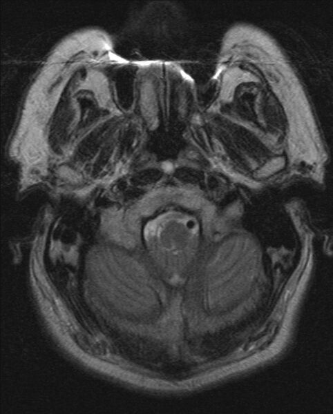 File:Cerebellopontine angle meningioma (Radiopaedia 24459-24764 Axial T2 2).jpg