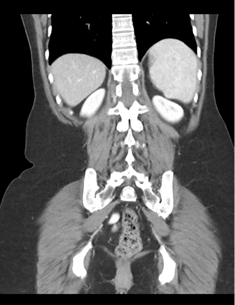 File:Cerebral abscess from pulmonary arteriovenous malformation (Radiopaedia 86275-102292 D 40).png