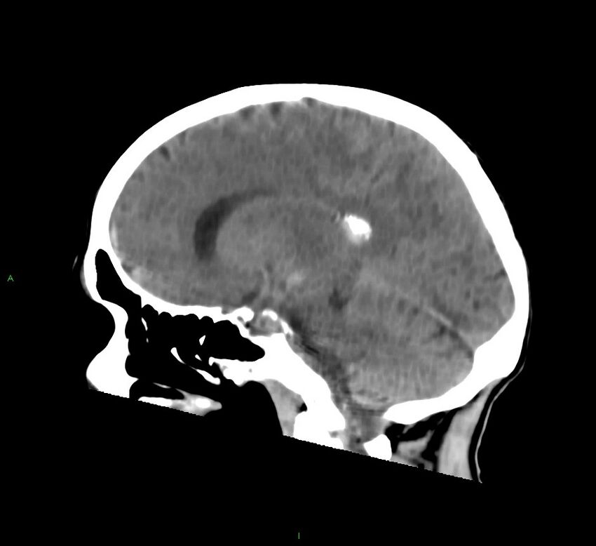 Cerebral amyloid angiopathy-associated lobar intracerebral hemorrhage (Radiopaedia 58758-65980 C 24).jpg