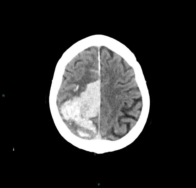 File:Cerebral amyloid angiopathy-associated lobar intracerebral hemorrhage (Radiopaedia 59356-66716 Axial non-contrast 11).jpg