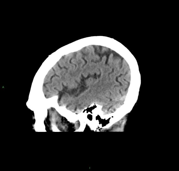 File:Cerebral amyloid angiopathy-associated lobar intracerebral hemorrhage (Radiopaedia 59356-66716 C 43).jpg