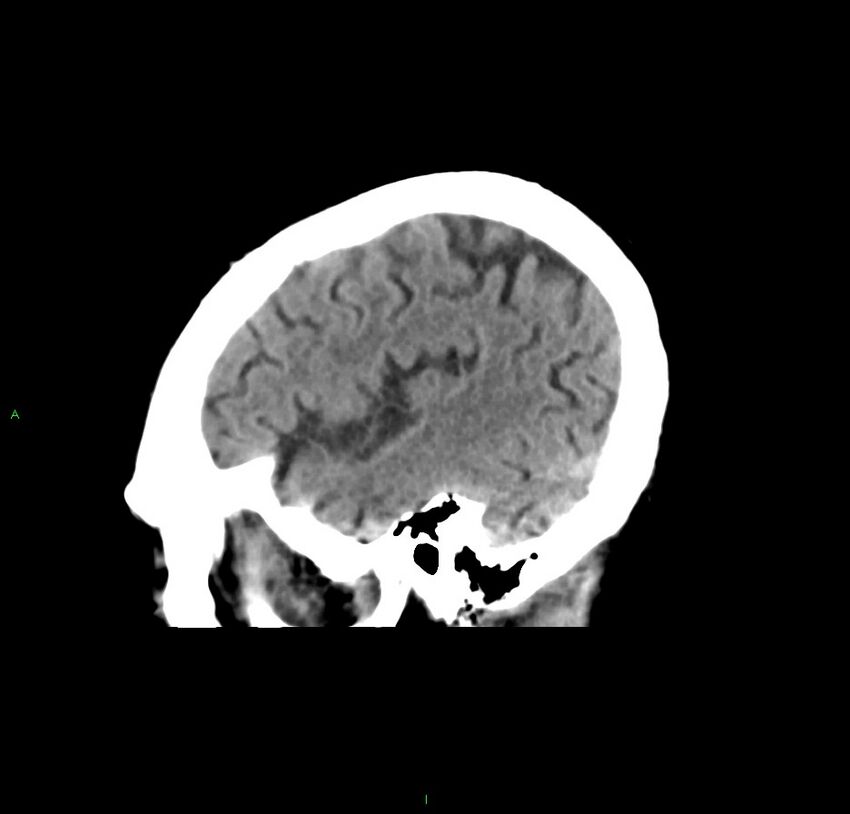 Cerebral amyloid angiopathy-associated lobar intracerebral hemorrhage (Radiopaedia 59356-66716 C 43).jpg