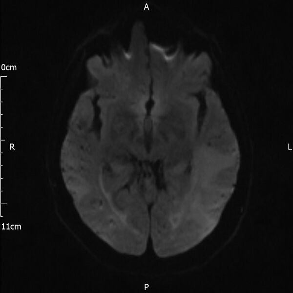 File:Cerebral amyloid angiopathy related inflammation (Radiopaedia 72772-83415 Axial DWI 34).jpg