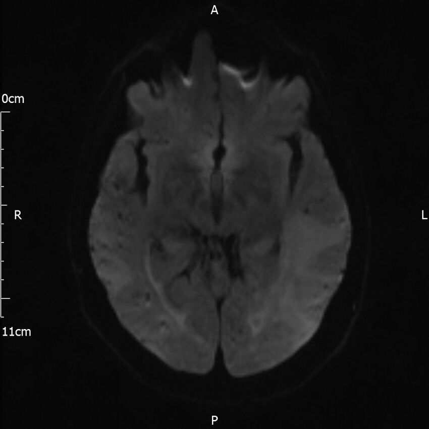 Cerebral amyloid angiopathy related inflammation (Radiopaedia 72772-83415 Axial DWI 34).jpg
