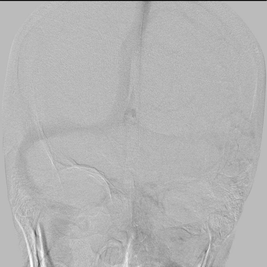 Cerebral aneurysm with rupture (Radiopaedia 29933-30458 LT ICA IC 26).jpg