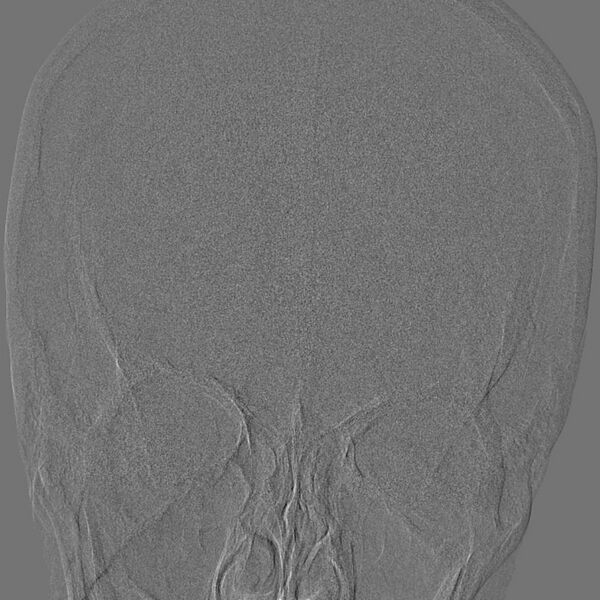 File:Cerebral aneurysm with rupture (Radiopaedia 29933-30458 LT ICA IC 5).jpg