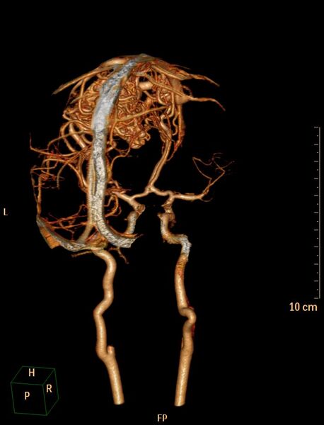 File:Cerebral arteriovenous malformation (Radiopaedia 29531-30031 B 10).jpg