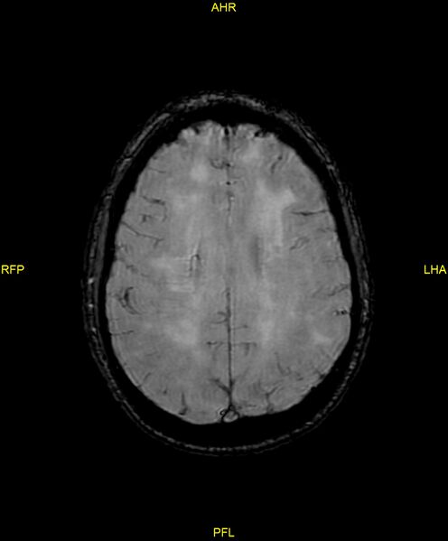 File:Cerebral autosomal dominant arteriopathy with subcortical infarcts and leukoencephalopathy (CADASIL) (Radiopaedia 86108-102054 Axial SWI 74).jpg