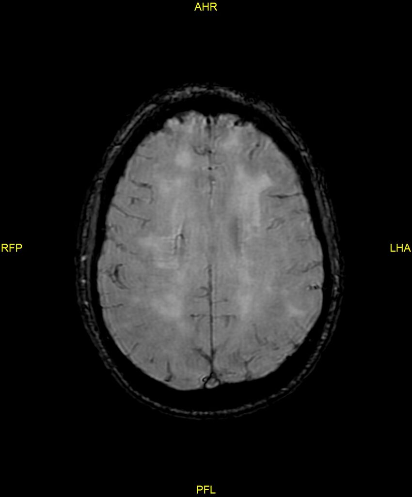 Cerebral autosomal dominant arteriopathy with subcortical infarcts and leukoencephalopathy (CADASIL) (Radiopaedia 86108-102054 Axial SWI 74).jpg