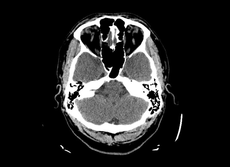 File:Cerebral edema (Radiopaedia 82519-96661 Axial non-contrast 43).jpg