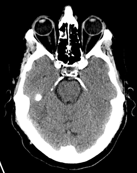 File:Cerebral embolic infarcts (embolic shower) (Radiopaedia 57395-64341 Axial non-contrast 11).png