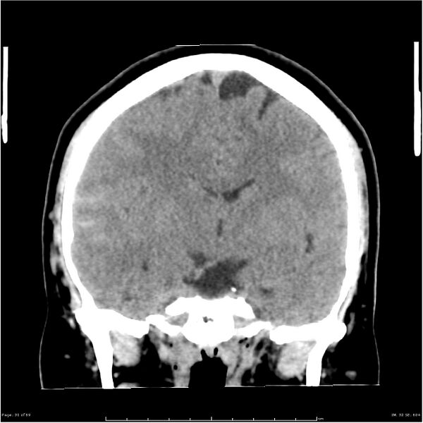 File:Cerebral hemorrhage secondary to arteriovenous malformation (Radiopaedia 33497-34561 Coronal non-contrast 22).jpg