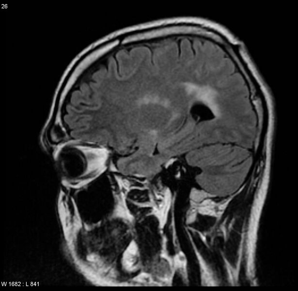 File:Cerebral vasculitis (Radiopaedia 5131-6923 Sagittal FLAIR 9).jpg