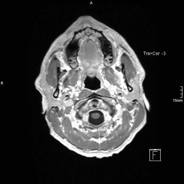 File:Cervical dural CSF leak on MRI and CT treated by blood patch (Radiopaedia 49748-54995 Axial T1 C+ 8).jpg