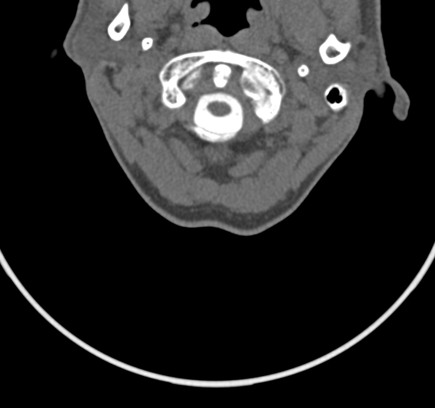 Cervical dural CSF leak on MRI and CT treated by blood patch (Radiopaedia 49748-54996 B 10).png