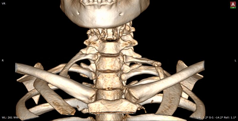 File:Cervical rib (Radiopaedia 71110-81364 Coronal 3D VR 1).jpg