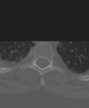 Cervical spine ACDF loosening (Radiopaedia 48998-54071 Axial bone window 62).png