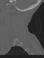 Cervical spondylolysis (Radiopaedia 49616-54811 Sagittal bone window 61).png