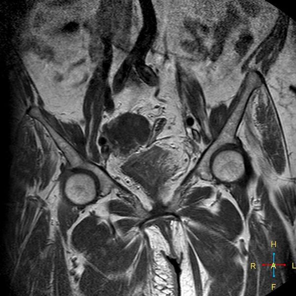 File:Cervical stump squamous cell carcinoma (Radiopaedia 48049-52858 Coronal T1 C+ 4).jpg