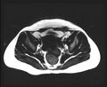 Cesarean section scar endometrioma (Radiopaedia 56569-63297 Axial T1 4).jpg