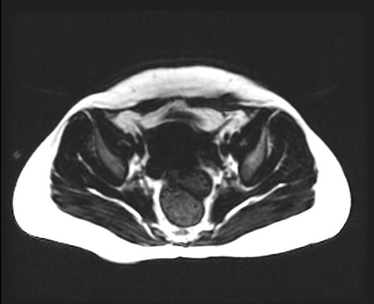 File:Cesarean section scar endometrioma (Radiopaedia 56569-63297 Axial T1 4).jpg